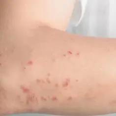 Skóra na ramieniu z licznymi czerwonymi, swędzącymi zmianami, które mogą być objawem reakcji na histaminę.