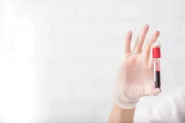 Ręka w rękawiczce trzyma probówkę z krwią, która może wskazywać na nadmiar potasu.