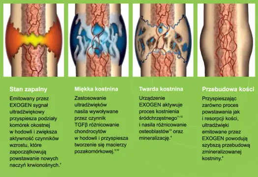 Co przyspiesza zrost kości po złamaniu? Dieta i leczenie