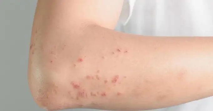 Histamina, alergia czy nietolerancja? Jak rozpoznać różnicę